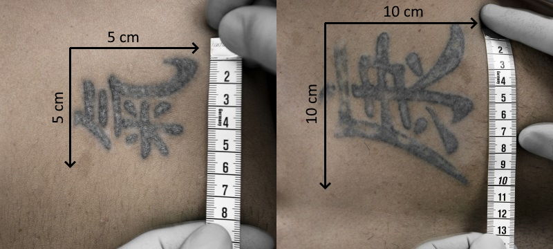 Grösse des Tattoos für die Tattooentfernung ausmessen – Länge und Breite in Zentimetern
