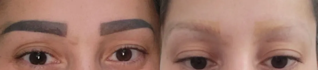Vorher-Nachher Foto einer Microblading-Entfernung nach 4 Behandlungen