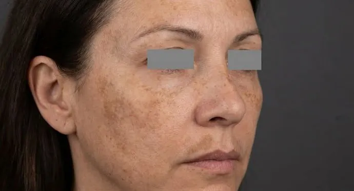 Pigmentflecken Entfernung mit dem PicoSure Laser