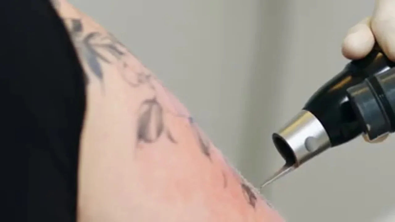 Andreas Baumgärtner im Interview mit Maxi von Beauty TV über Tattooentfernung mit dem PicoSure-Laser