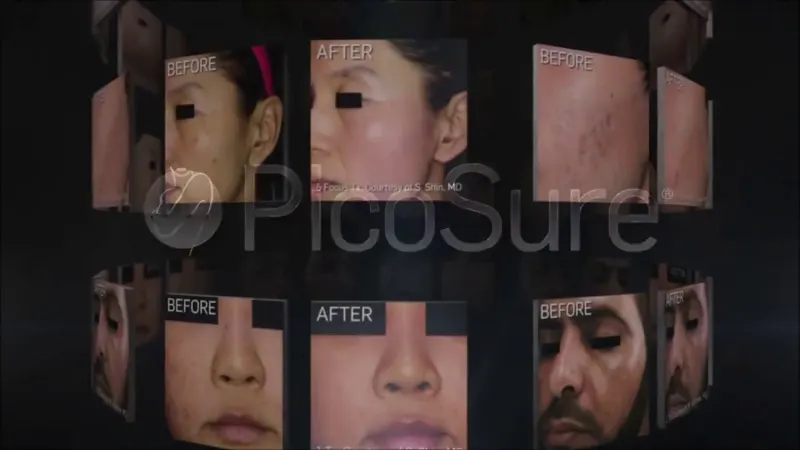 Thumbnail: video about the PicoSure laser